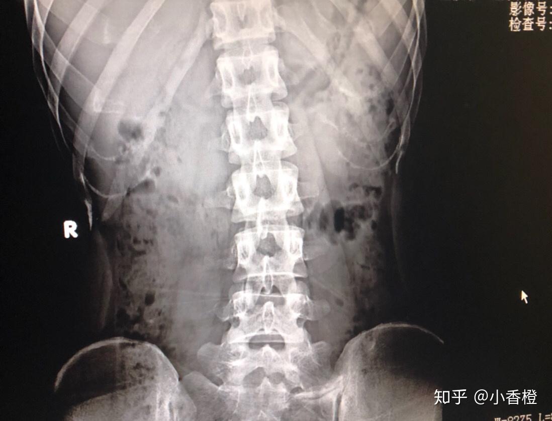 腰间盘突出怎么办之医院的经历