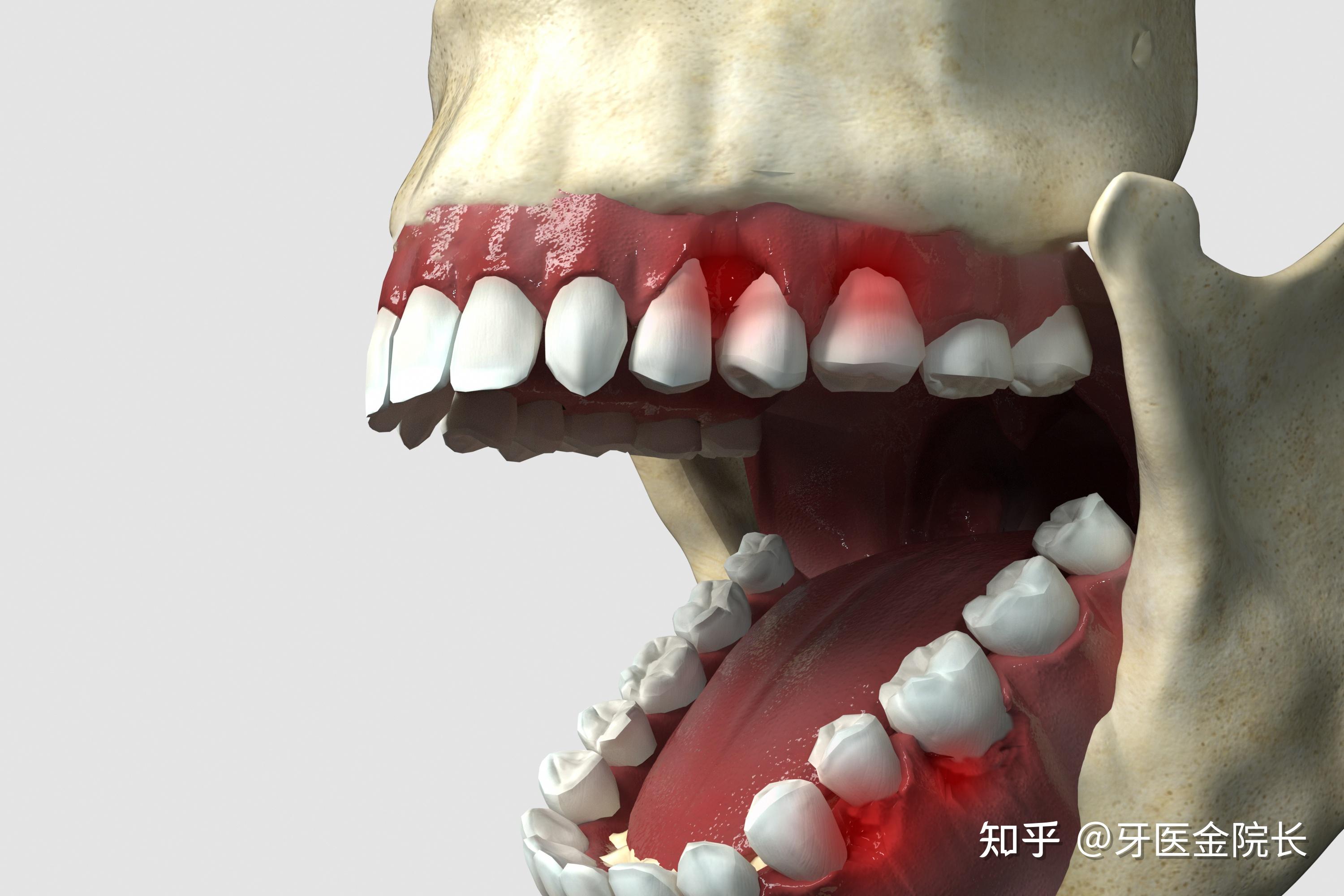 重度牙周炎患者:松动牙,牙龈萎缩,死活不愿拔!——为啥医生坚决反对? - 知乎