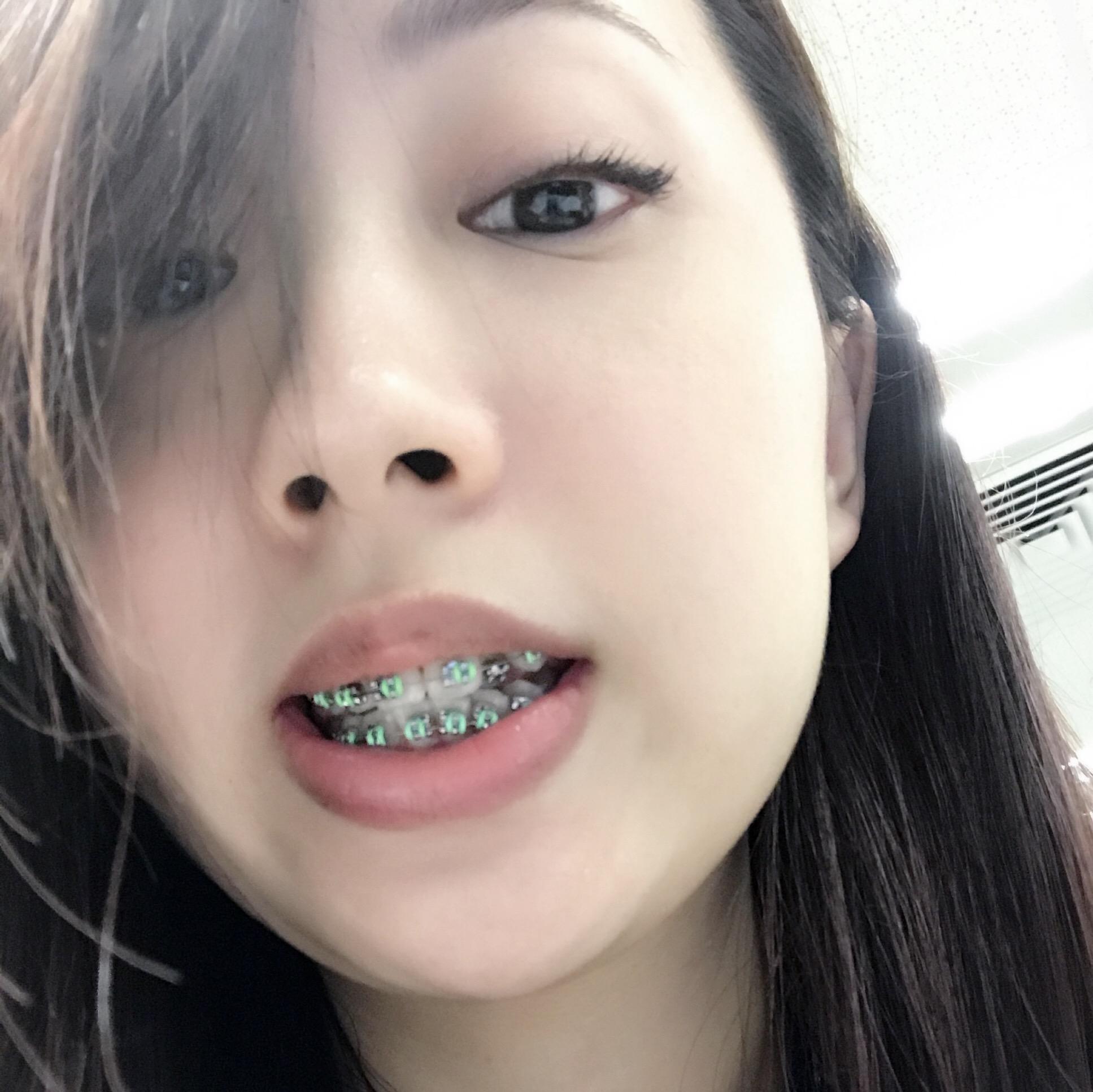 大钢牙也可以美美的! - 知乎