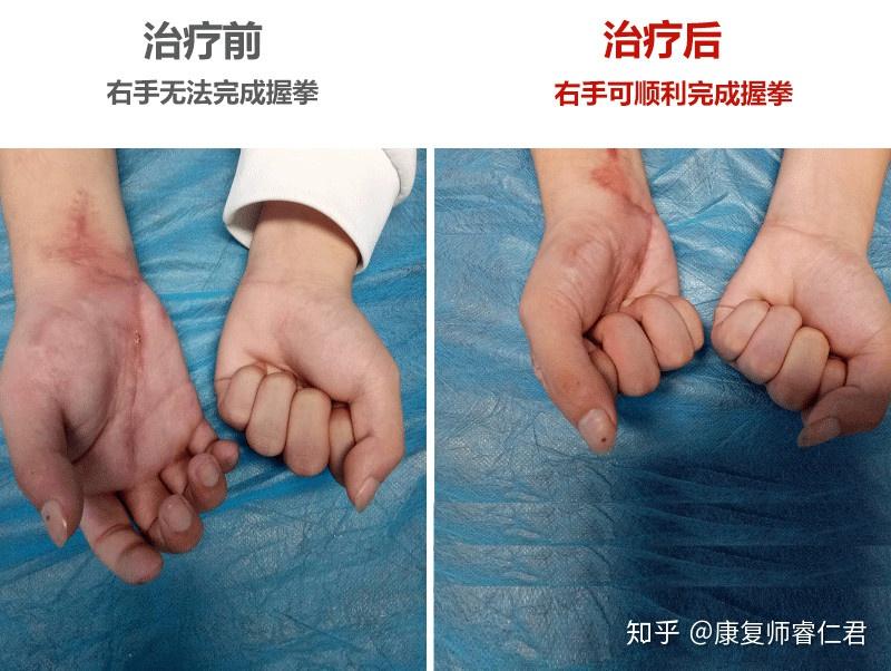 手外伤骨折案例—17岁男孩功能康复历程