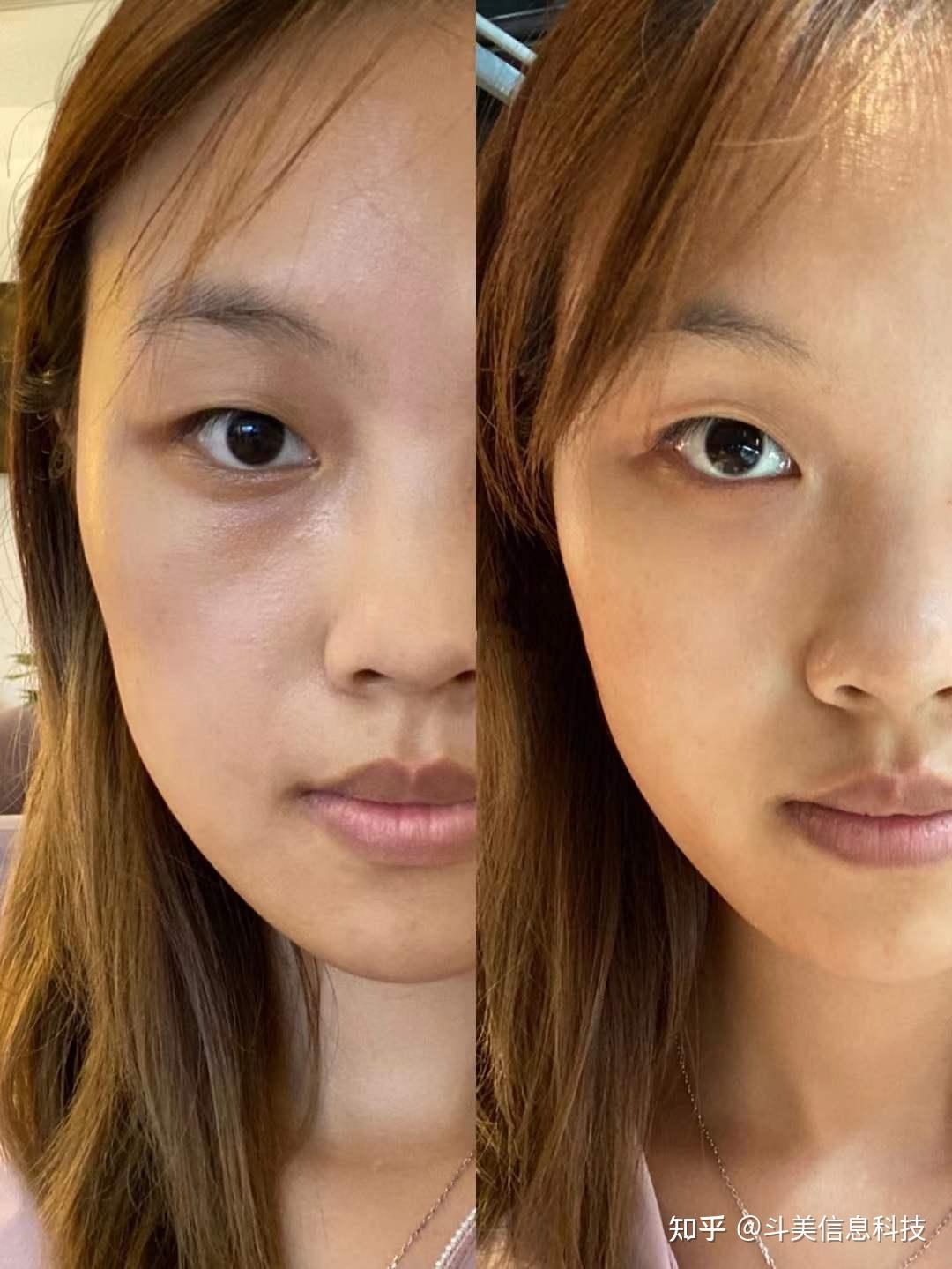 深圳哪家整形医院的医生做面部自体脂肪填充比较好? - 知乎