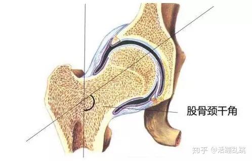 正常股骨有一個15°的前傾角,如果股骨前傾角比較大的話,為了髖關節更