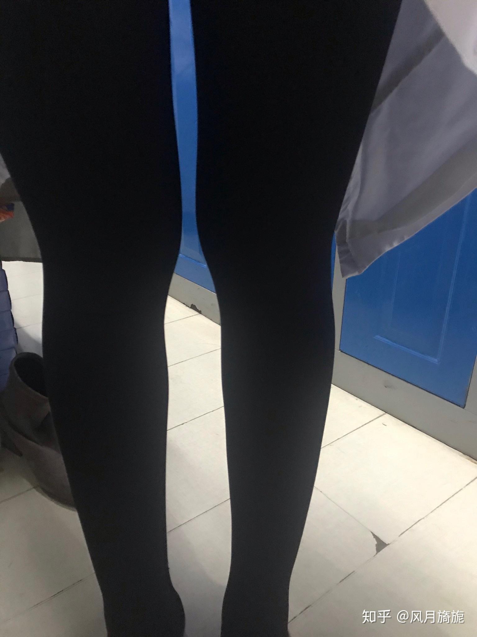 这种xo型腿是因为骨头弯吗