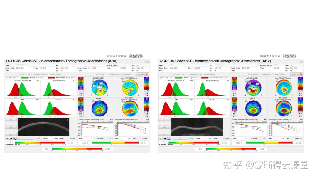 圆锥角膜的RGP验配及RGP临床效果分析（文字版） - 知乎