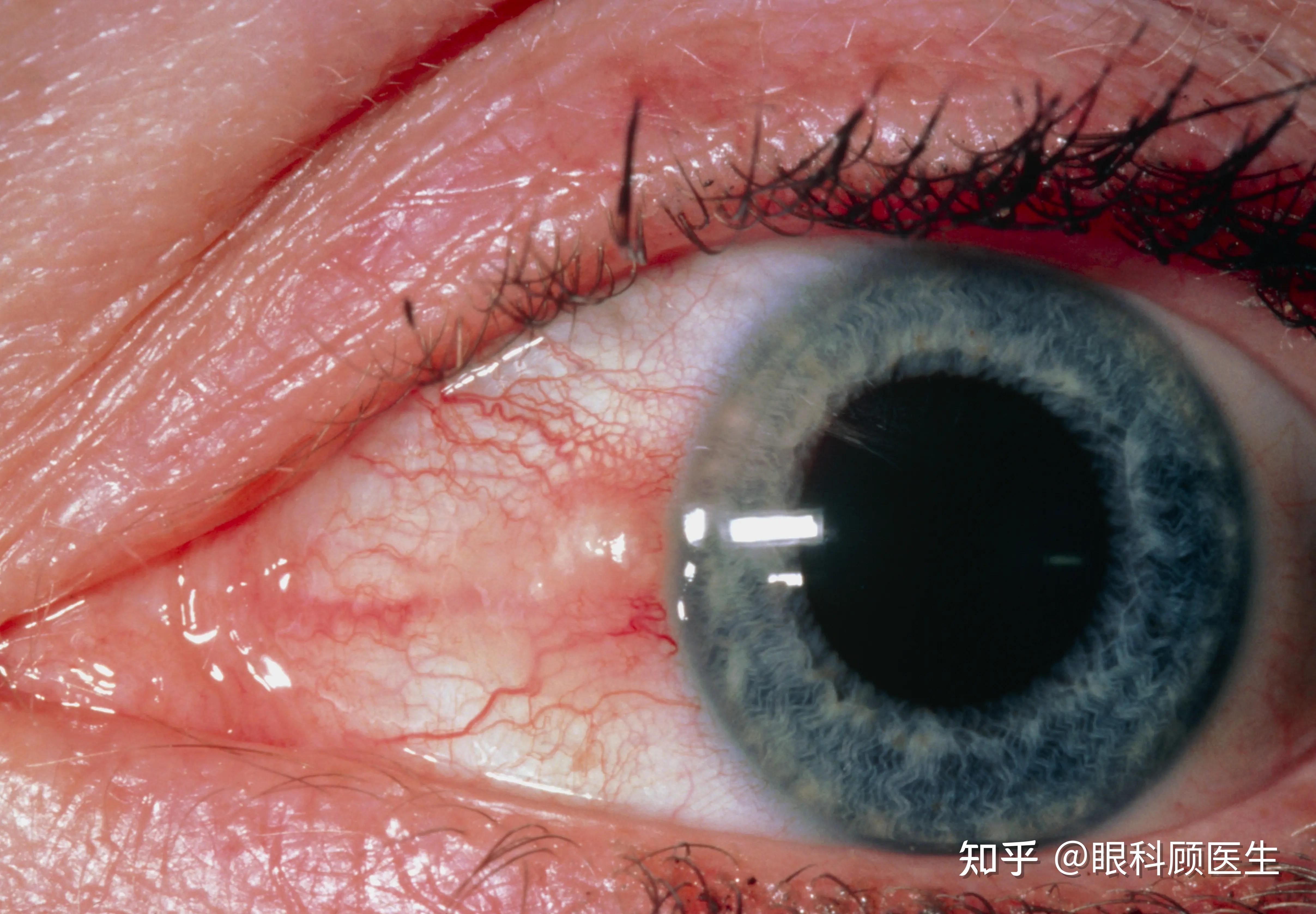 瞼裂斑への手術｜吉野眼科クリニック 最新鋭のレーシック・白内障・多焦点眼内レンズ（老眼）手術は、東京上野の眼科／レーシックセンター