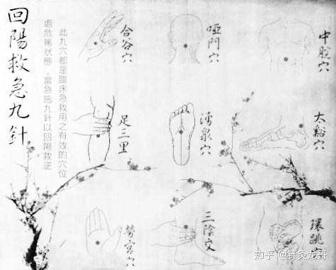 回阳九针——带你走进神奇的针灸世界 - 知乎
