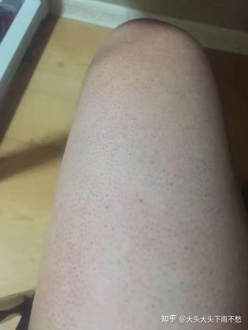 生完小孩小腿大腿鸡皮肤(生完孩子大腿皮肤粗糙像鸡皮)