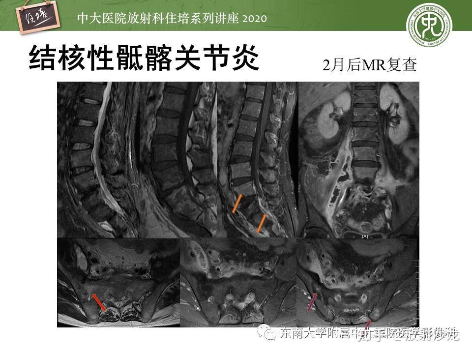 常见骶髂关节病变的影像表现