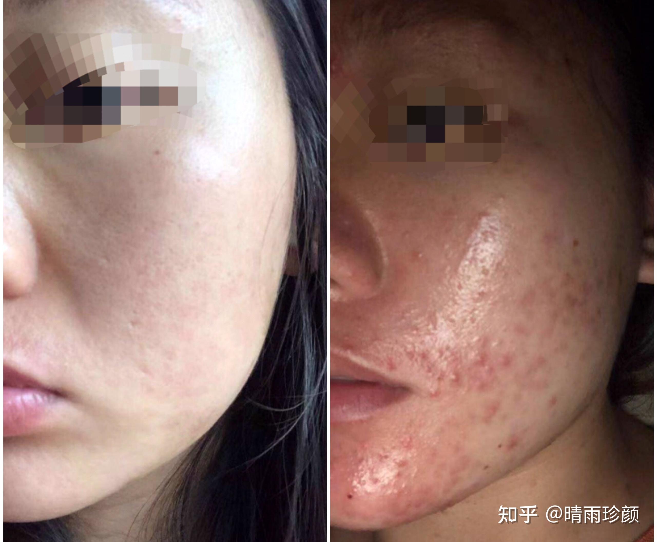 为什么针清容易留坑 医院皮肤科还要针清？ - 知乎