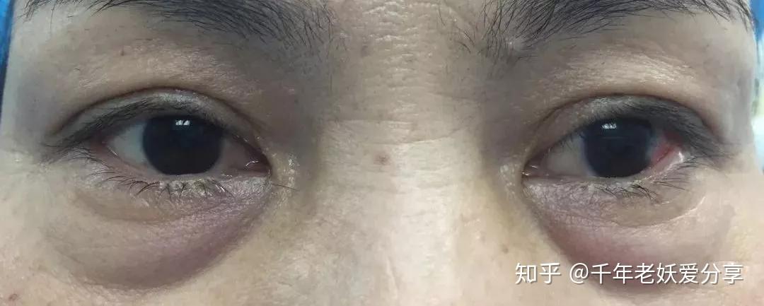 40歲之後眼袋黑眼圈是如何形成的原因既然是它