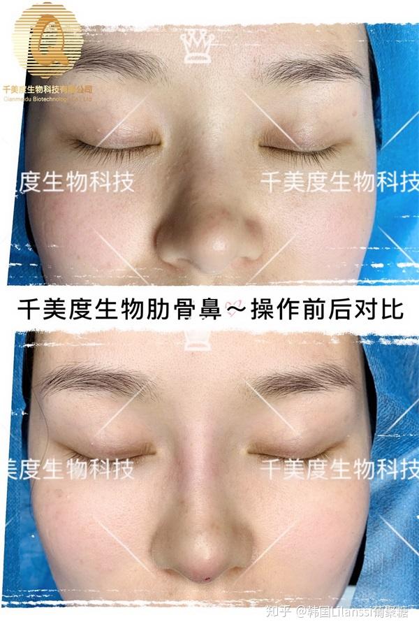 licol生物肋骨鼻可以做吗用对方法锁住美丽时光