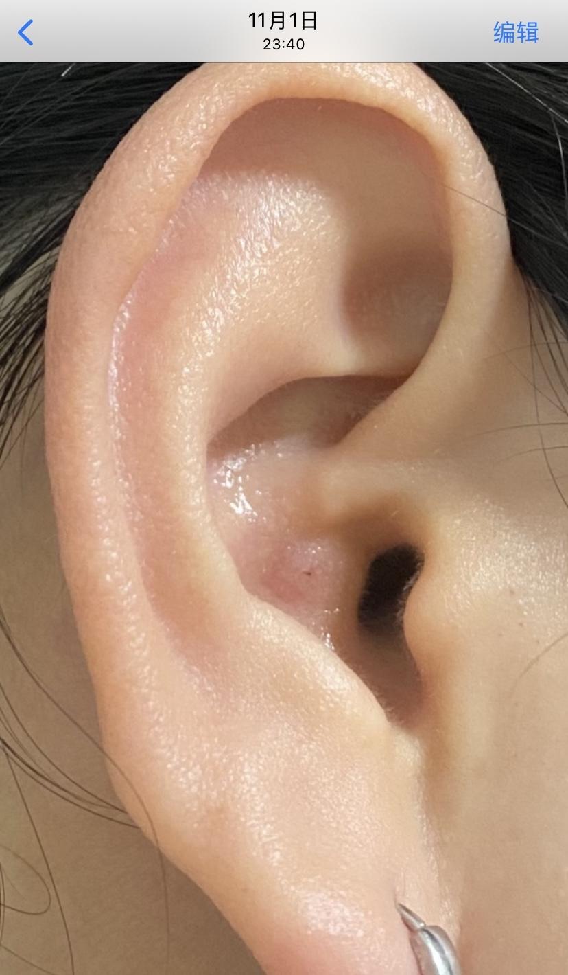 怎样对付外耳道的疖肿