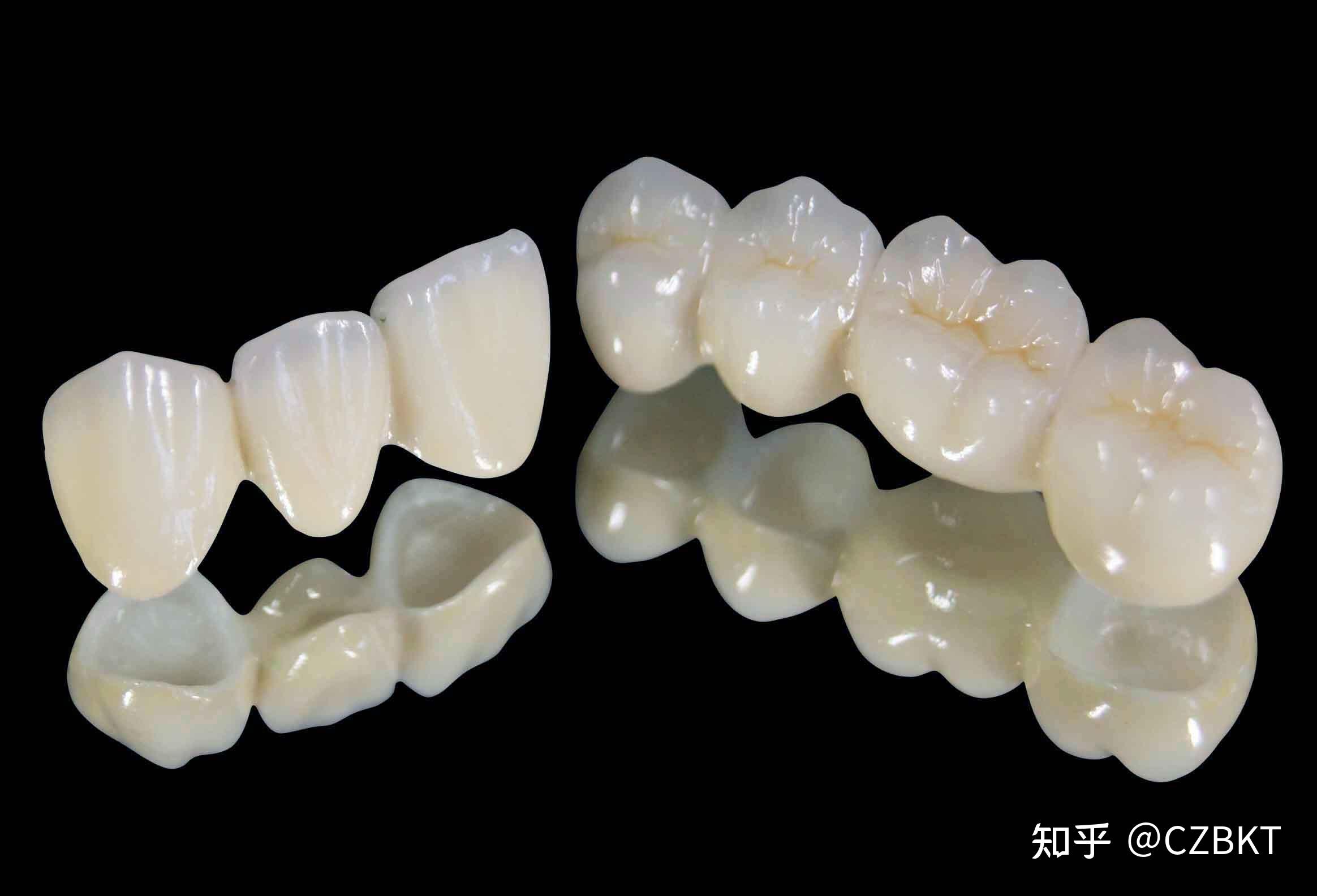 种植牙由三部分组成:种植体(人工牙根),基台(连接部位),牙冠