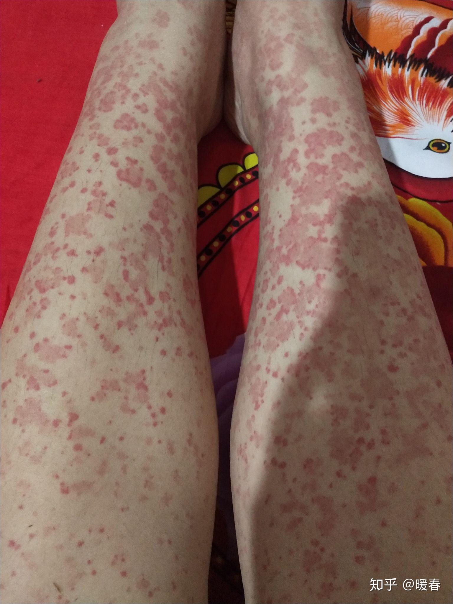 过敏性紫癜反复多年治不好是一种什么体验怎么调整自己的心态