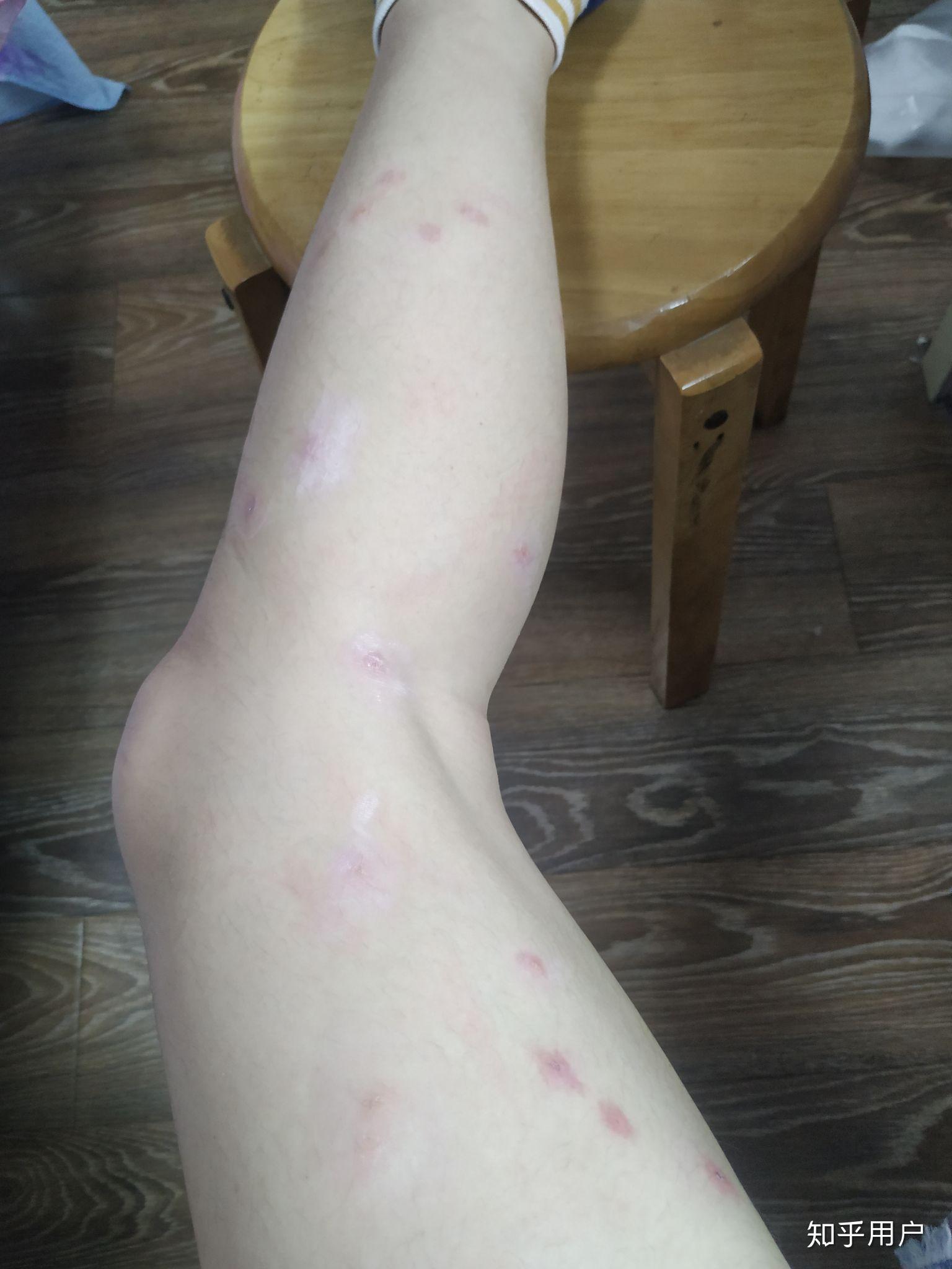 被蚊子咬了五十个包,如何快速消肿? - 知乎