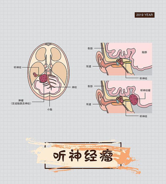 听神经瘤解剖位置图片