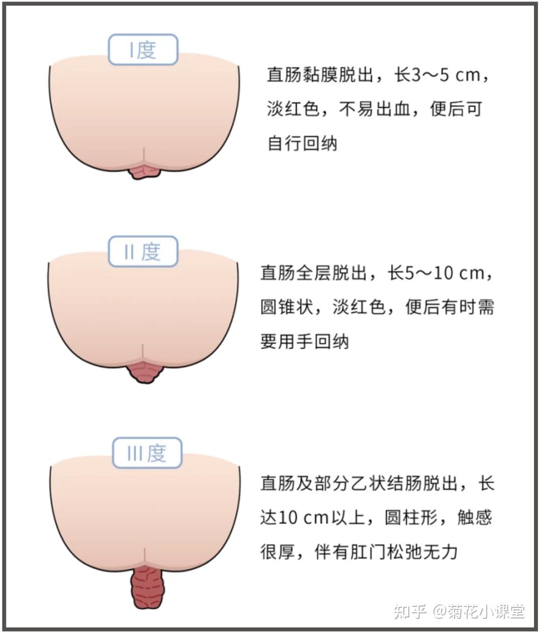 肛门处长了一个小肉球图片