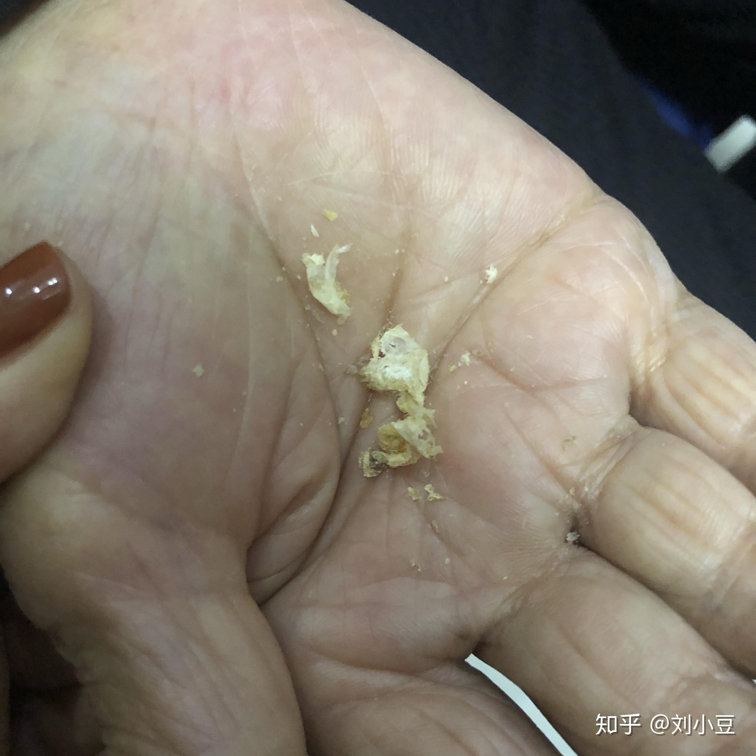 耳屎能大到什么程度