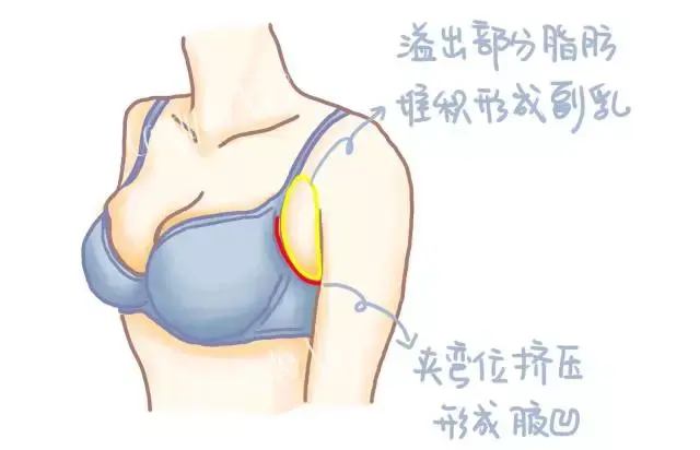 长期穿胸托真的可以改善附乳吗
