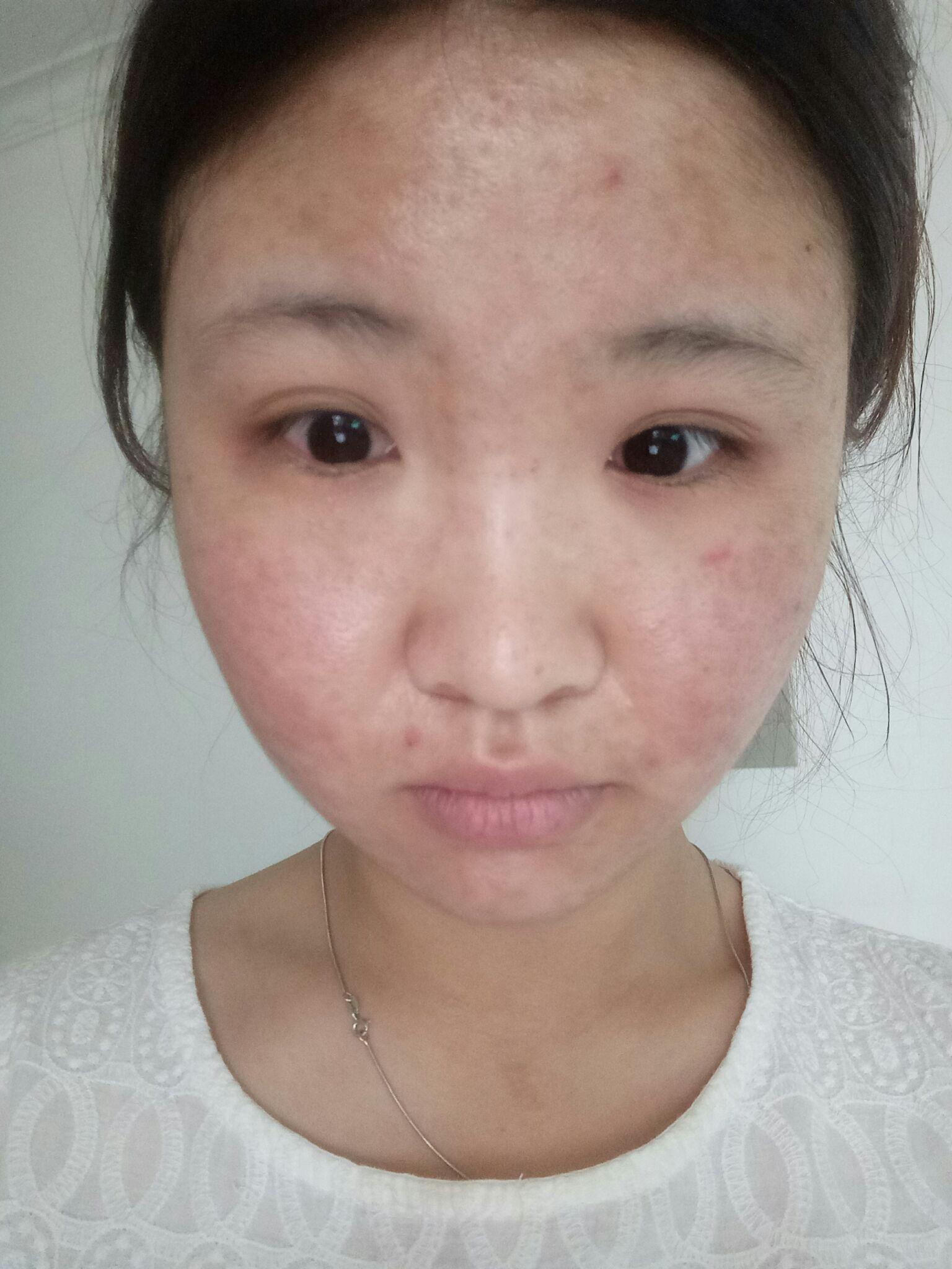 明明脸长的很精致身材没的说却总有冒不完的痘痘各种痘是一种什么体验