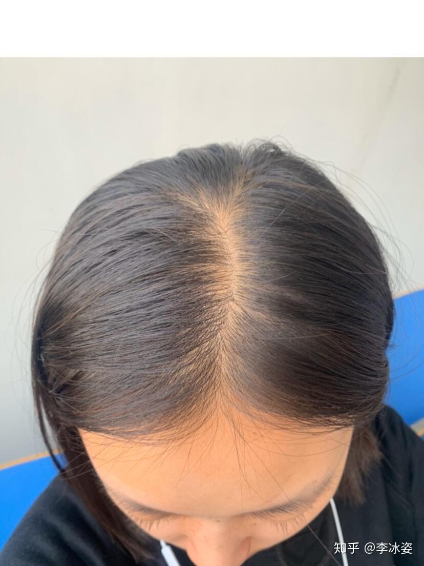 作为一个女生却有脂溢性脱发,我该怎么办? - 知乎