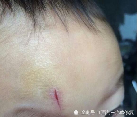 两周岁的宝宝脸上有疤痕怎么消除好