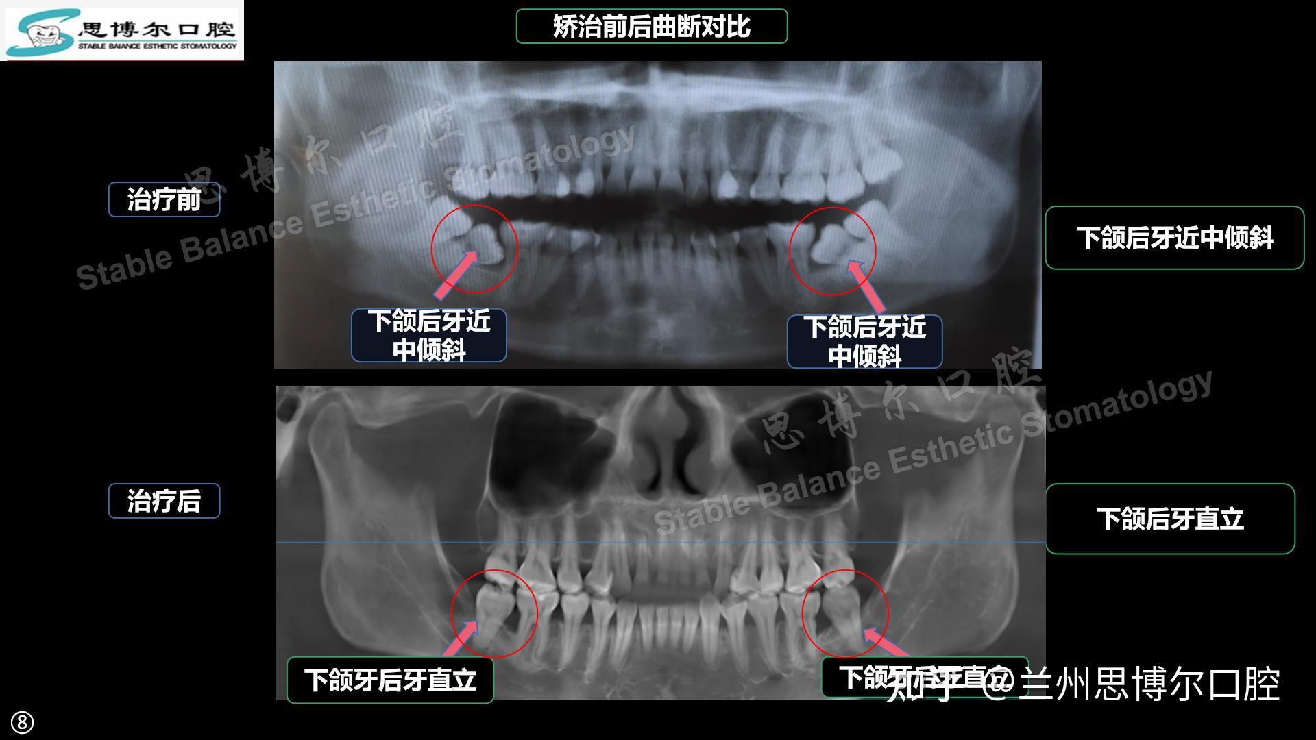 下頜雙側第二磨牙近中傾斜矯治案例