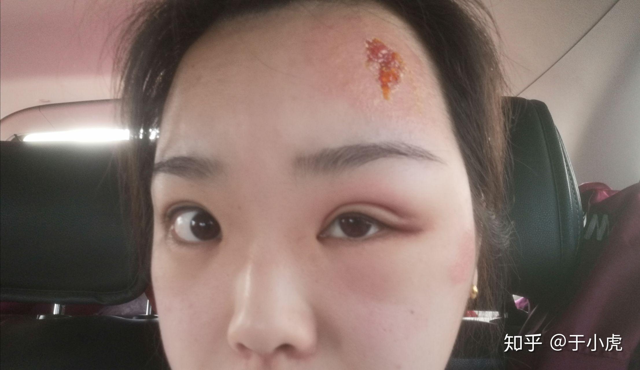 从小到大被蚊子咬肿很大的包而且流脓 有什么好的办法解决 ? - 知乎