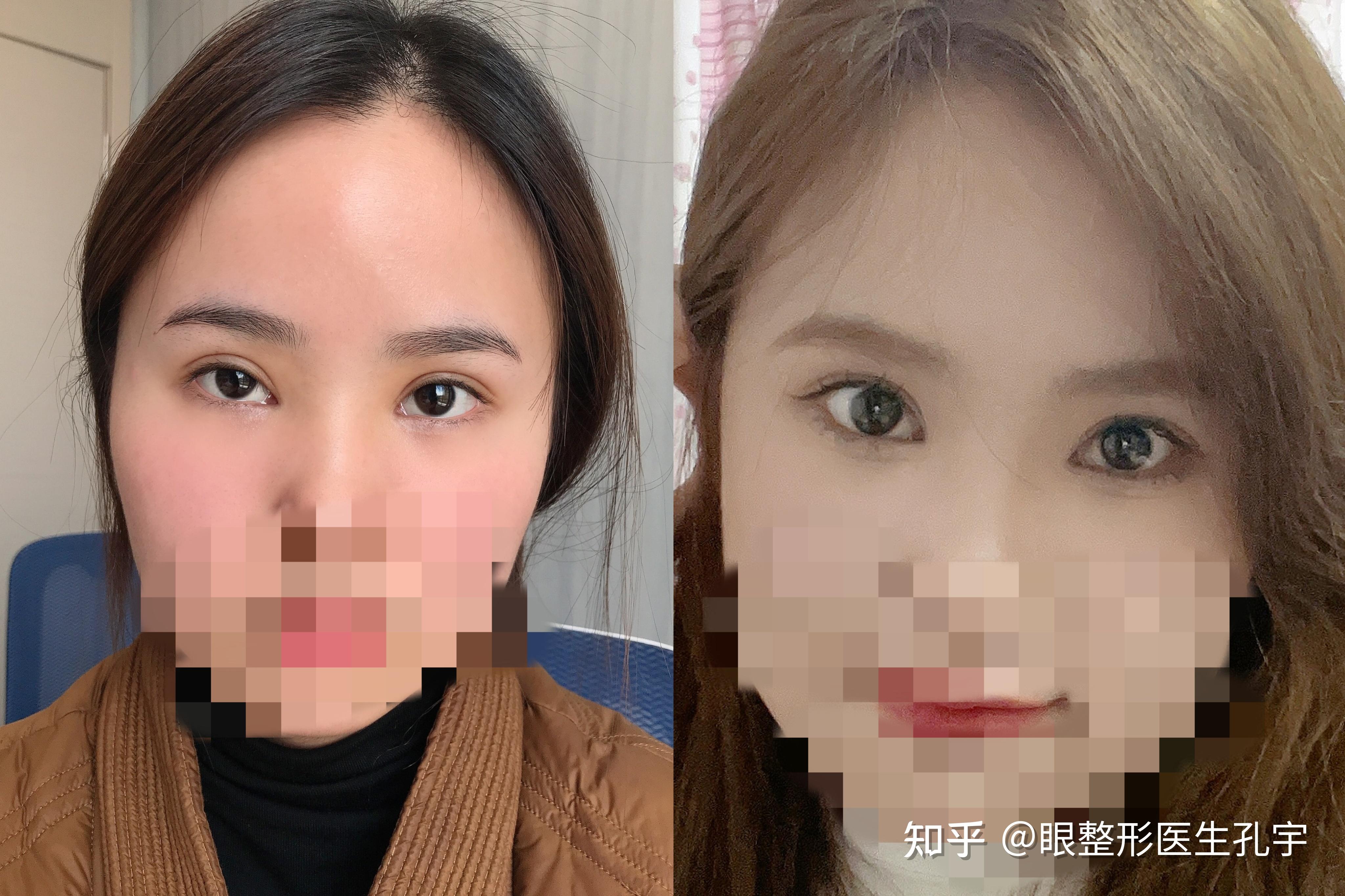 为什么眼睛一大一小 为什么眼睛一大一小