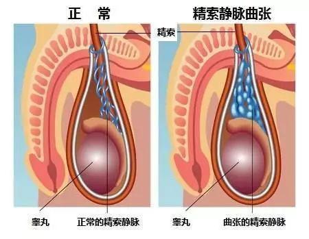 为什么精索静脉曲张多发生在左侧