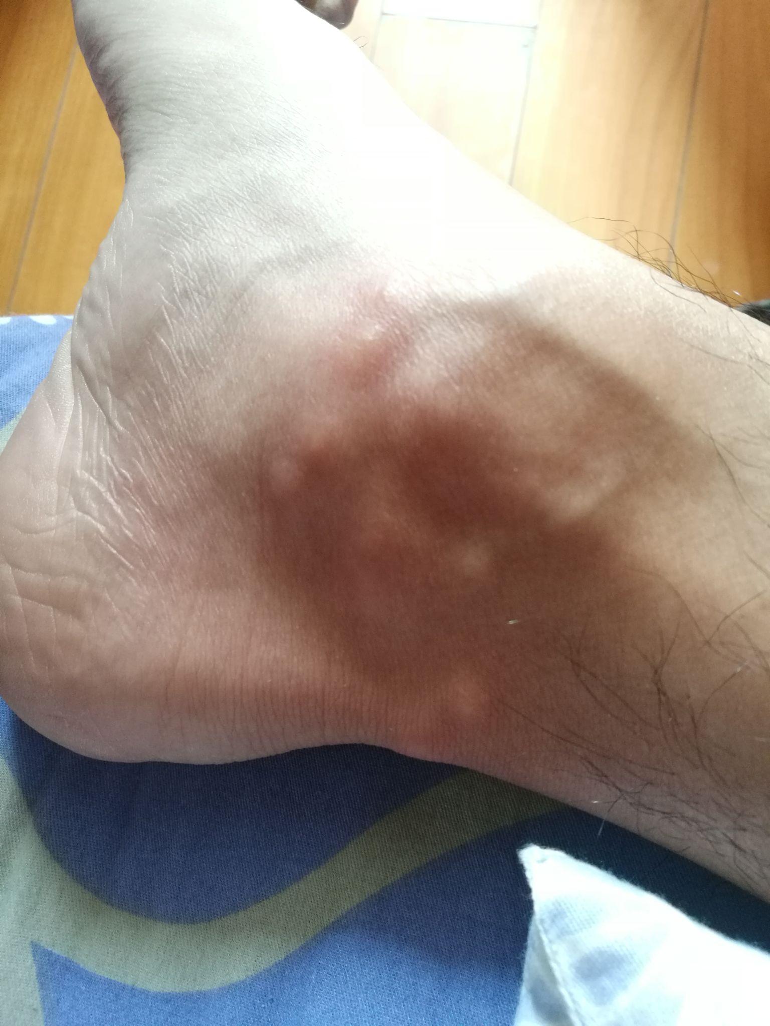 脚踝处长了很多小包,很痒? - 知乎