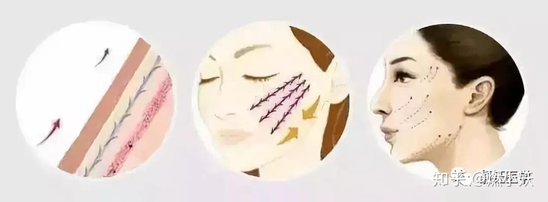 究竟什么是线雕?