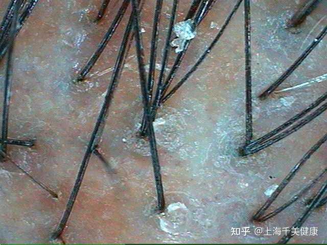 秋冬常见头皮问题图片解读 - 知乎