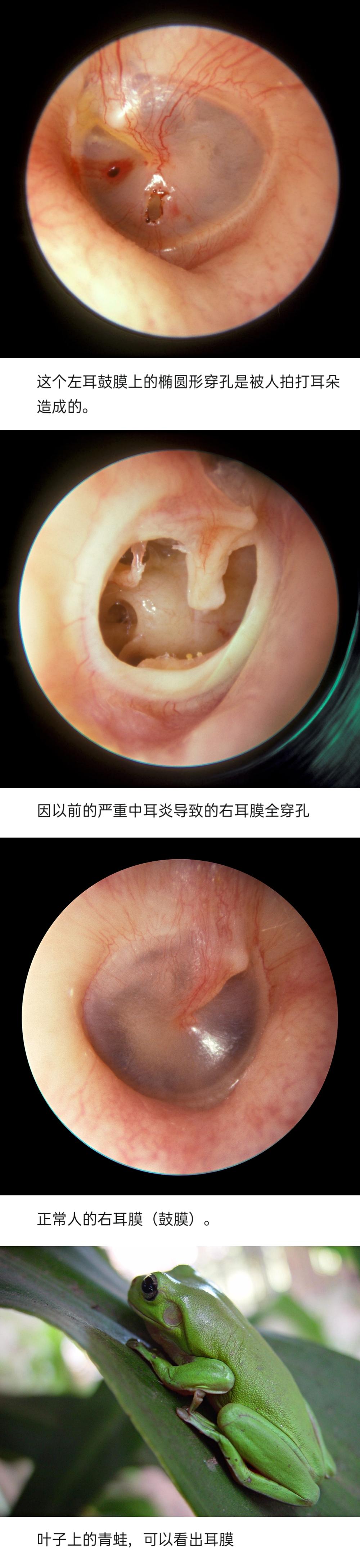 鼓膜上有白色覆盖物图片