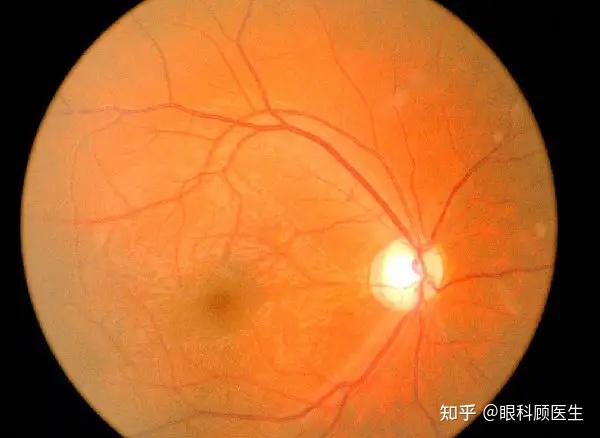 视神经外伤会造成什么后果?