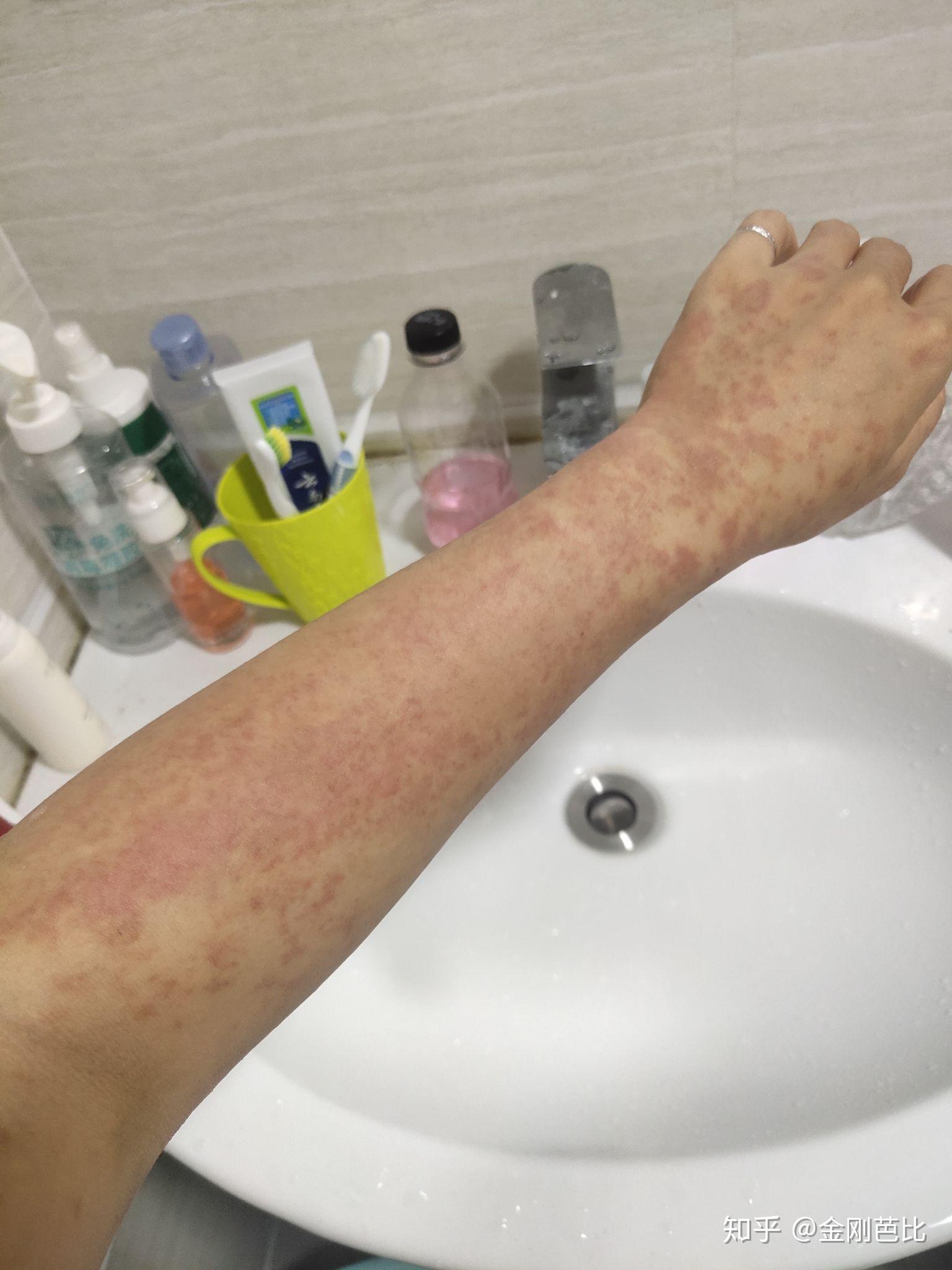 得了多形性红斑,怎么才能痊愈啊?要忌什么吗? - 知乎