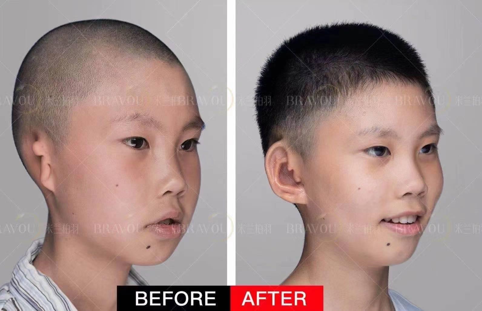 小耳畸形孩子做了外耳再造后多久可以恢复怎么护理更好