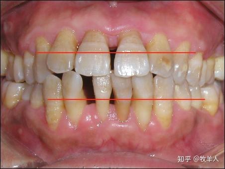 最终导致牙齿松动,脱落.