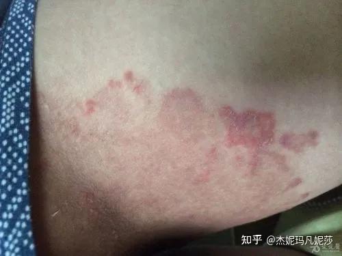 大腿内侧和睾丸特别痒? - 知乎