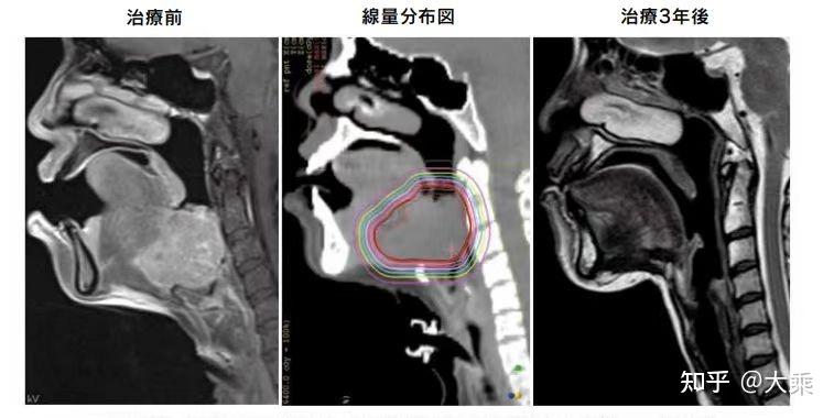 不可切除的舌根部癌，首选治疗方案还是重粒子 - 知乎