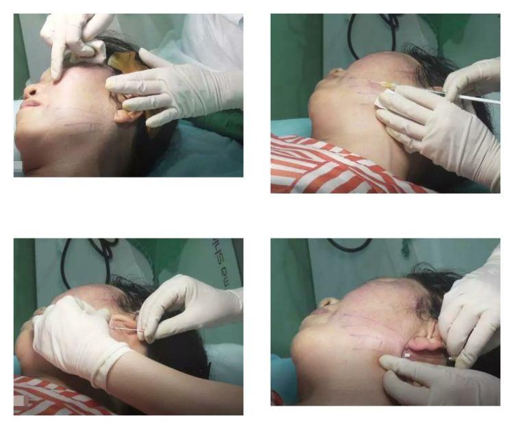 北京八大处布仁埋线提升案例线雕手术步骤