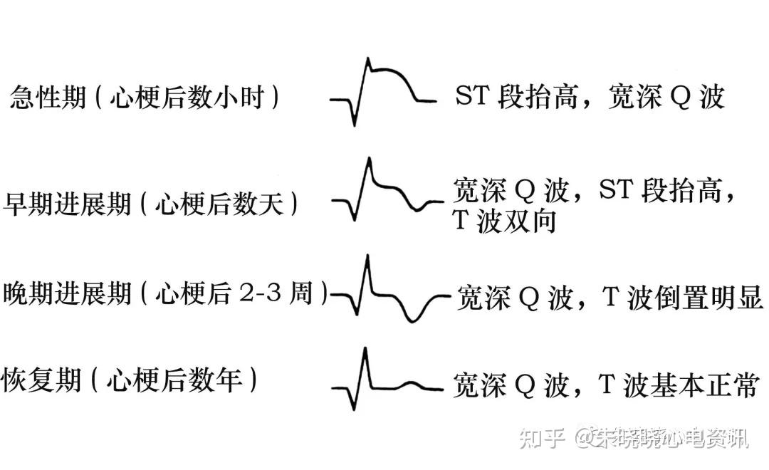 多变的T波,如何鉴别诊断 - 知乎