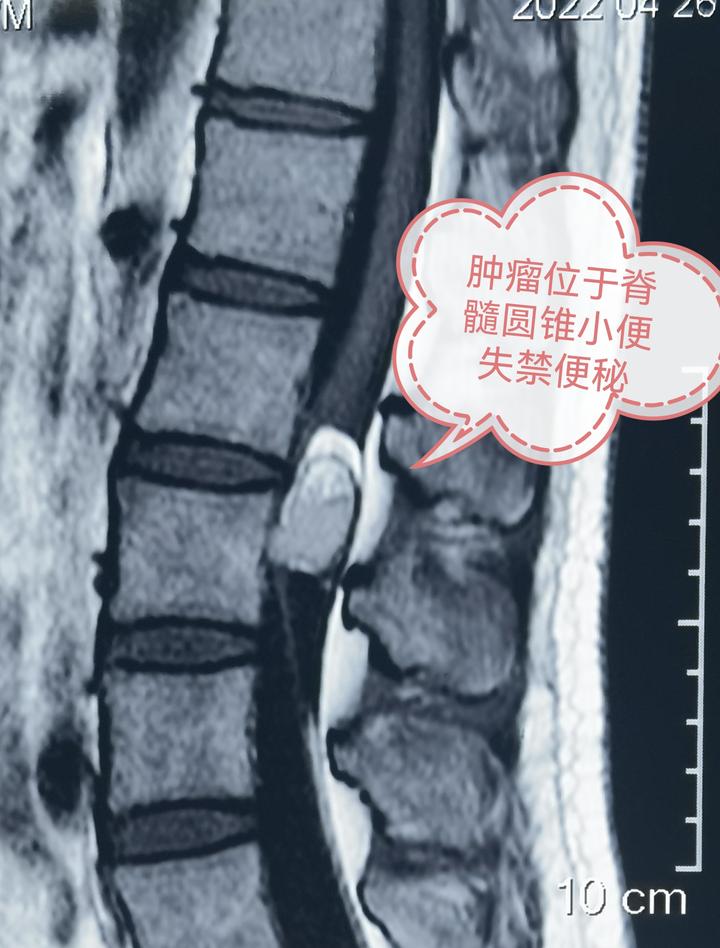 脊髓圆锥肿瘤术后会瘫痪