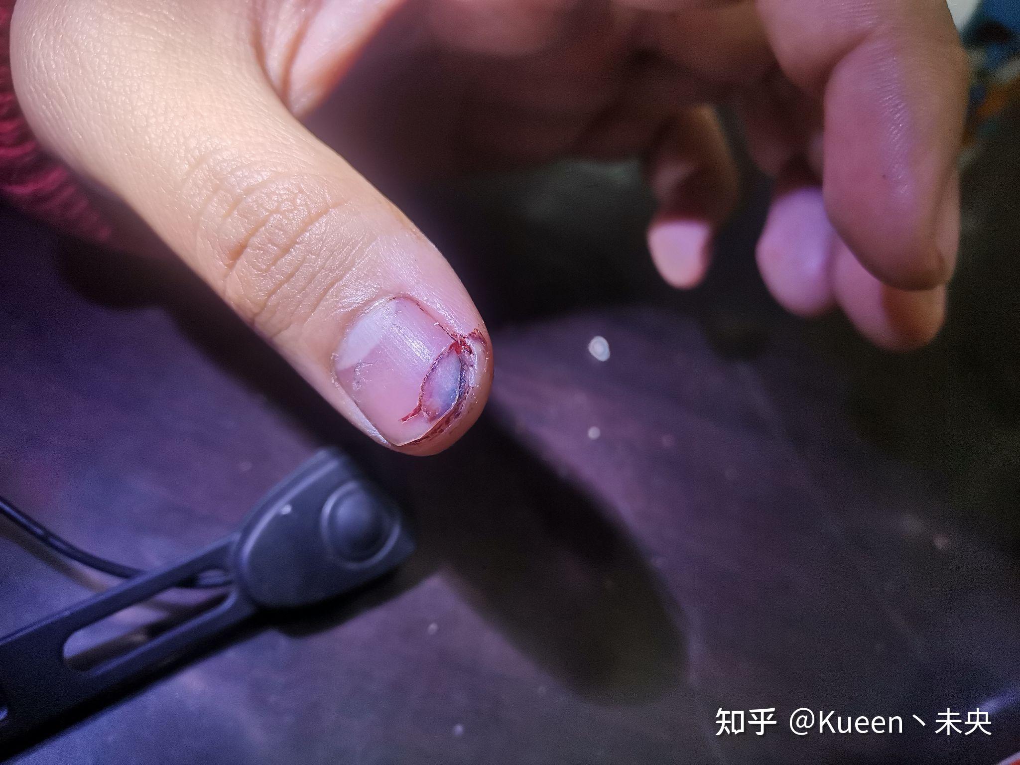 指甲从中间断了怎么快速愈合
