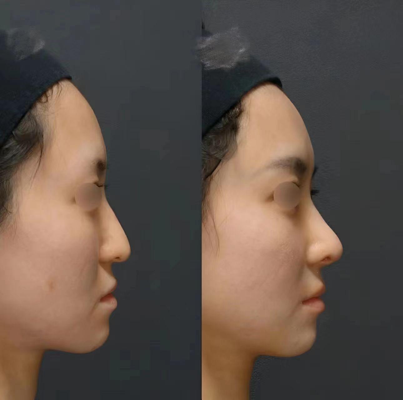 双侧耳软骨，假体+耳软骨+原生鼻翼软骨塑形隆鼻 - 知乎