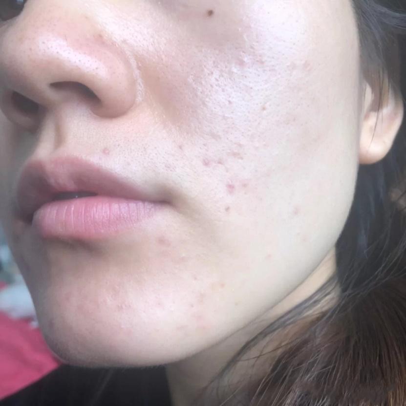 脸上的小痘坑会自行消退吗