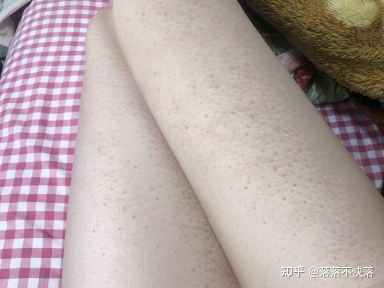 大腿小腿鸡皮肤怎么去除(大腿小腿鸡皮肤怎么快速消除)