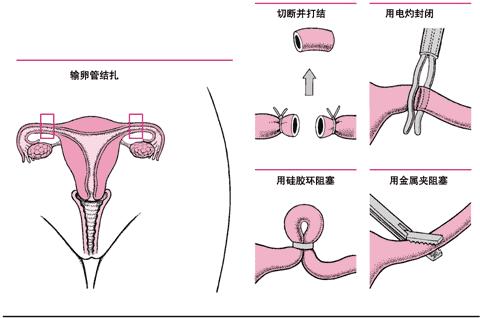 結紮後生育二胎,能順利恢復生育能力嗎?