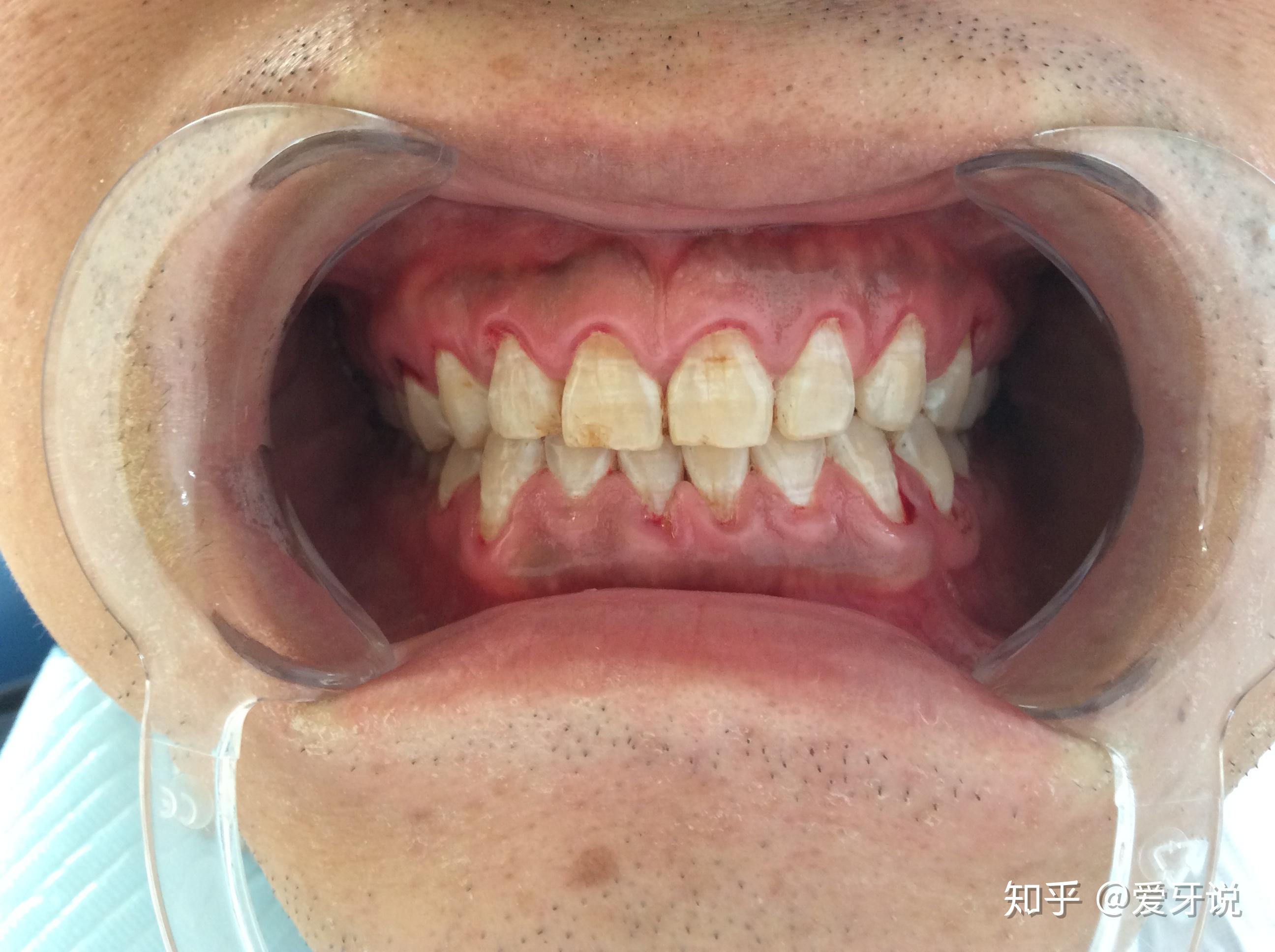 牙医必备收藏的图片合集，口腔常见的疾病图片。 - 知乎