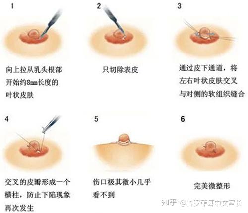 乳头内陷矫正术价目表图片